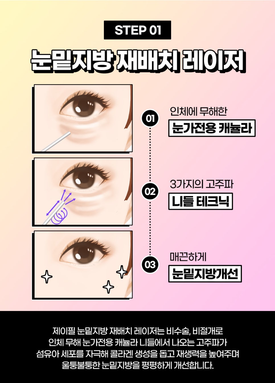 눈밑노화, 비수술 비절개 눈밑하안검으로 관련 이미지 4