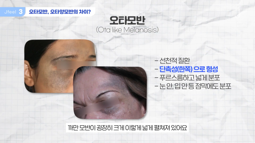 기미 주근깨 잡티에 이 시술만은 NO! 시술 전 필독 관련 이미지 5