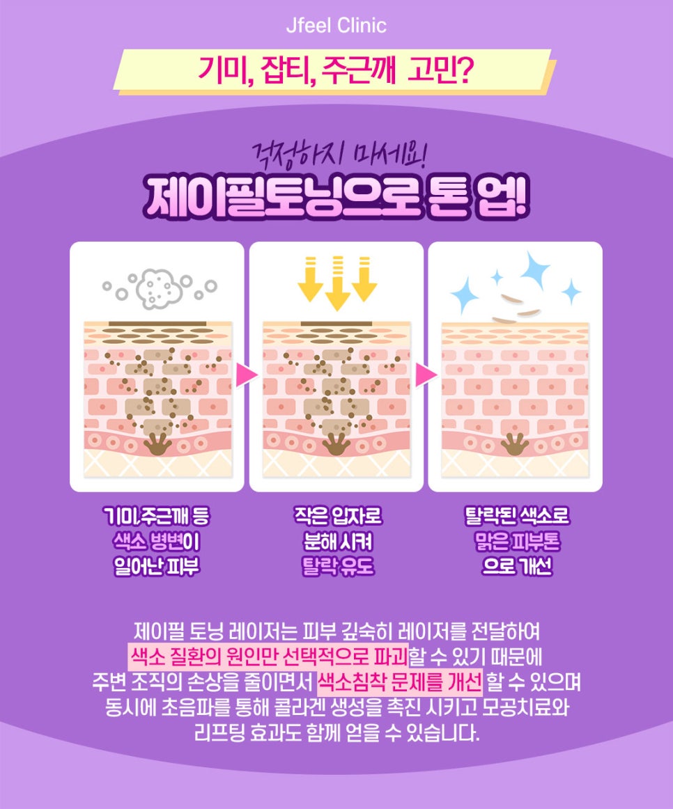 기미,잡티 레이저토닝으로 효과를 볼수있을까요? 관련 이미지 4