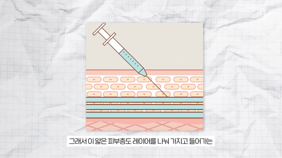 필러가 싫다면? 눈가, 팔자, 주름 해결하는 울트라콜 관련 이미지 17