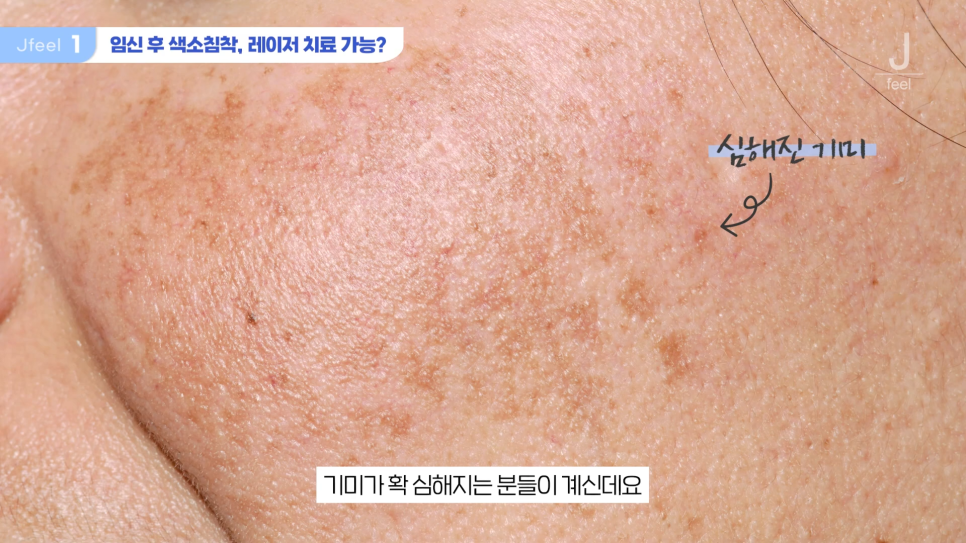임산부피부과 시술 가능한가요? Q&A 관련 이미지 2