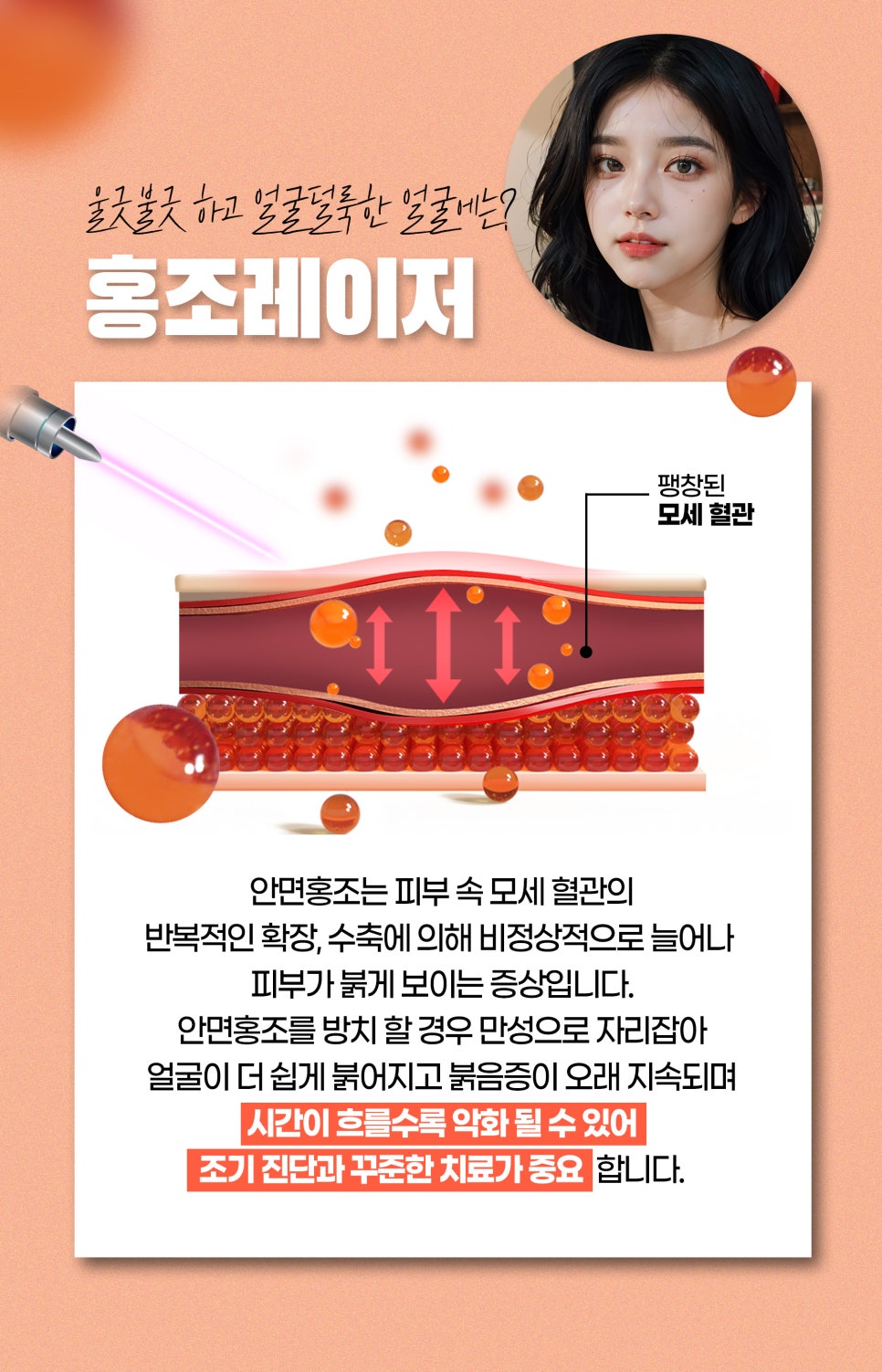 홍조없애기, 홍조레이저와 크라이오셀 관련 이미지 3