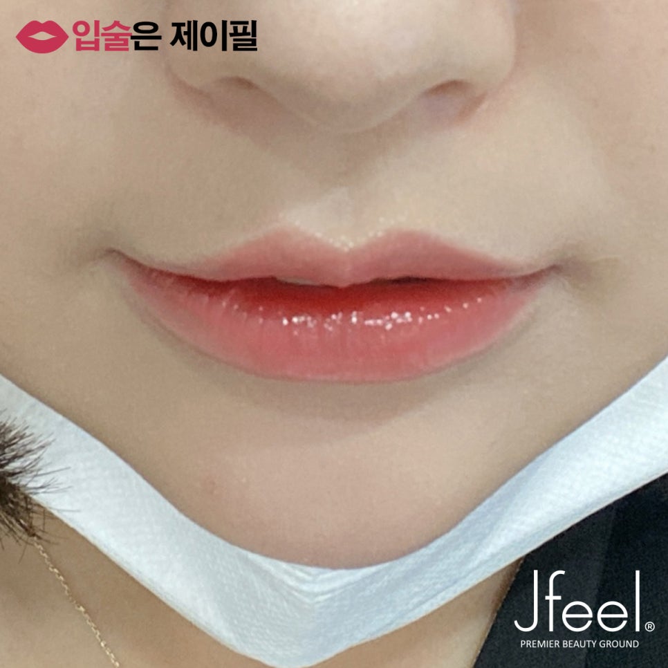 입술필러 맞고 조심해야 할 점, 주의사항, 통증, 붓기 관련 이미지 1