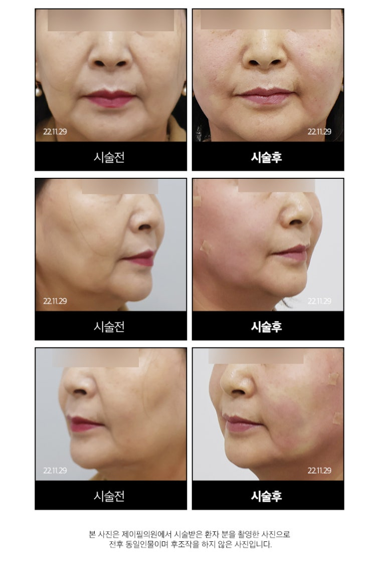 실리프팅 전문병원 선택 기준 총정리 ㅣ 실 종류&middot;디자인&middot;노하우&middot;의료진 경험 관련 이미지 21