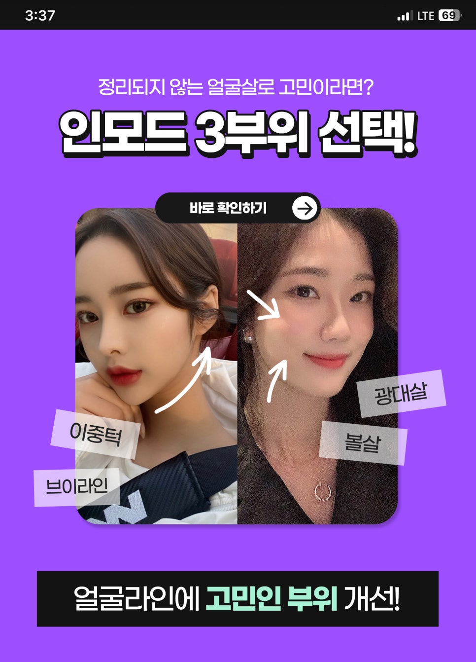 얼굴라인정리, 트리플 착붙인모드로 한 번에 관련 이미지 6