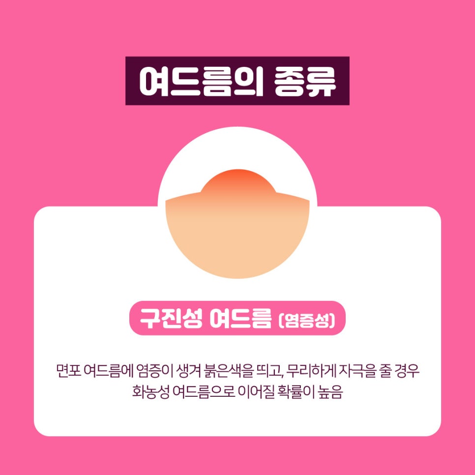 화농성여드름에도 탁월한 여드름레이저 관련 이미지 6