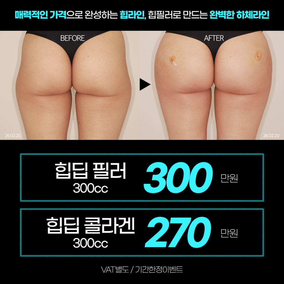 Solving Lower-Body Line Concerns, Creating Apple Hips with J-FILL Hip Filler and Butt Filler image 3