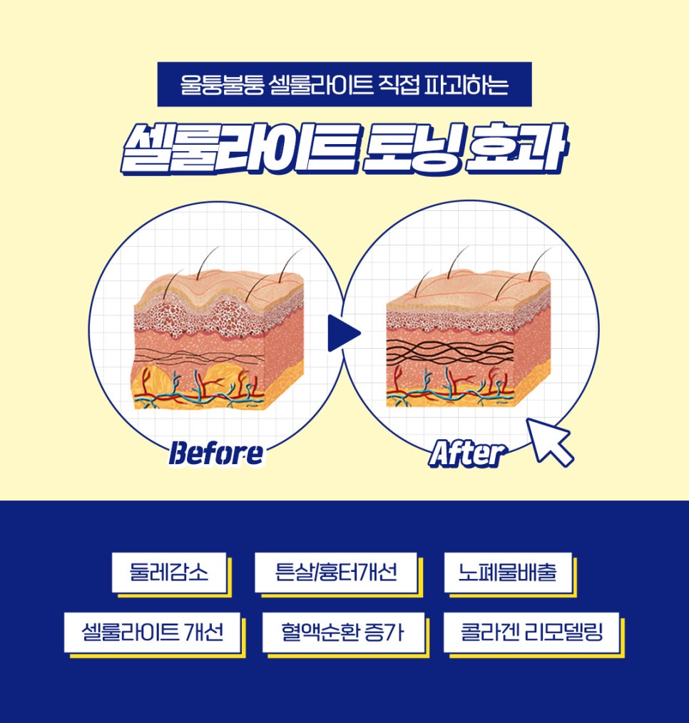 바디리프팅으로 처진 살, 셀룰라이트 해결 관련 이미지 10