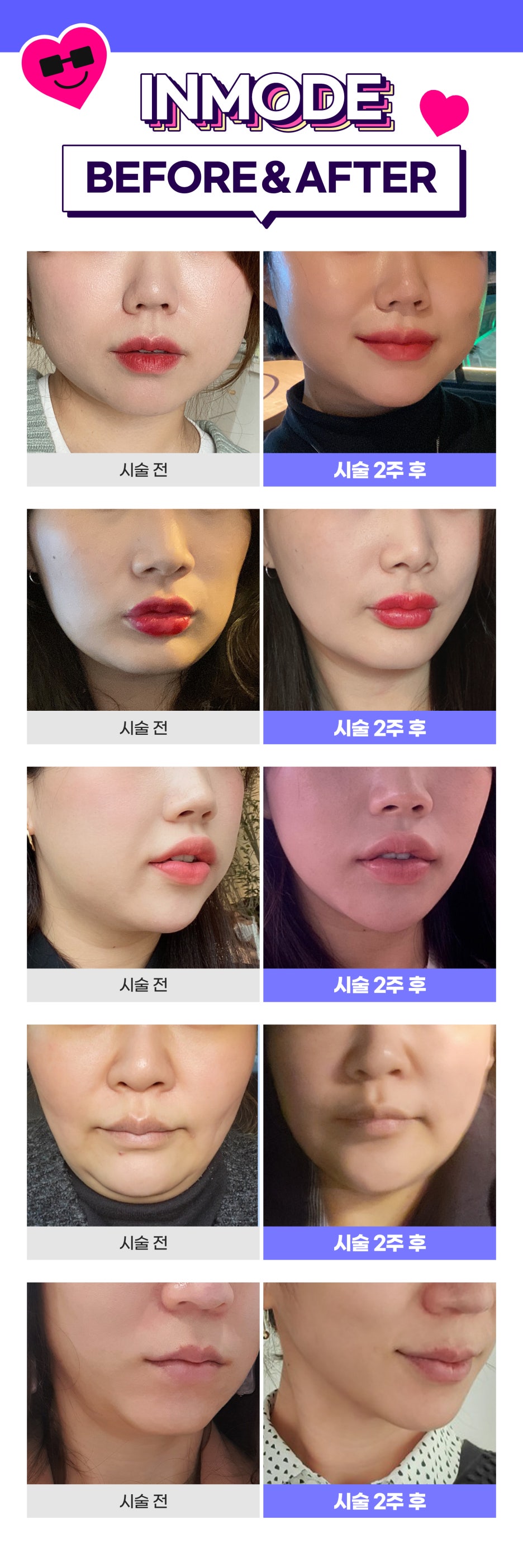 인모드리프팅레이저로 하관집중 케어하기 관련 이미지 8