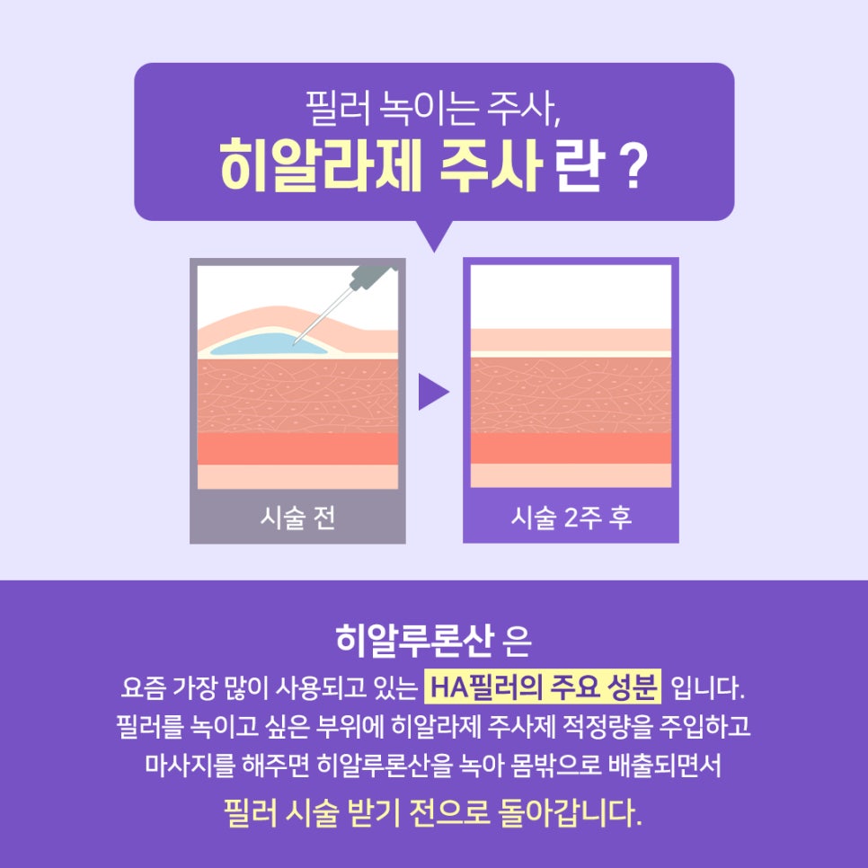 필러녹이는 주사 히알라제로 남김없이 깔끔하게! 관련 이미지 2