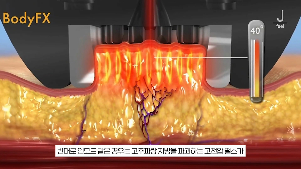 인모드와 튠페이스&튠라이너 차이점 관련 이미지 13