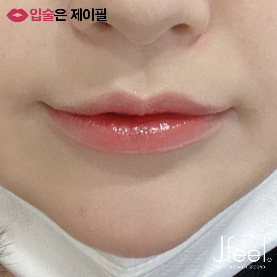 입술필러 맞고 조심해야 할 점, 주의사항, 통증, 붓기 관련 이미지 2