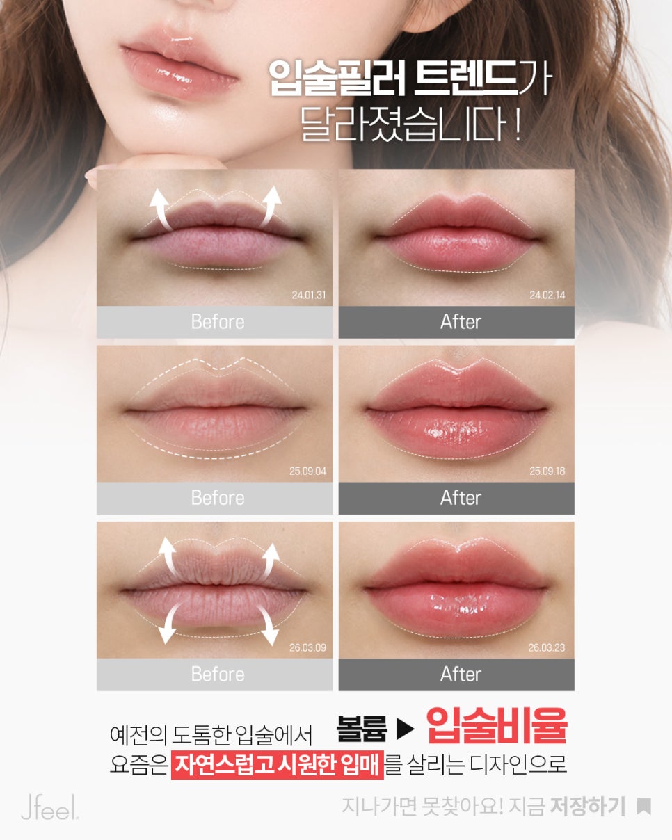 입술필러 후기부터 가격·붓기까지! 요즘 유행하는 입술확장 필러는 뭐가 다를까? 관련 이미지 7