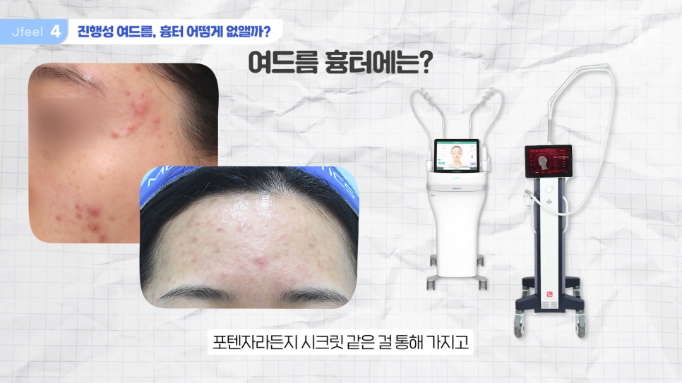 수능 후 피부과시술 추천, 고3& 사회 초년생 필독 관련 이미지 17