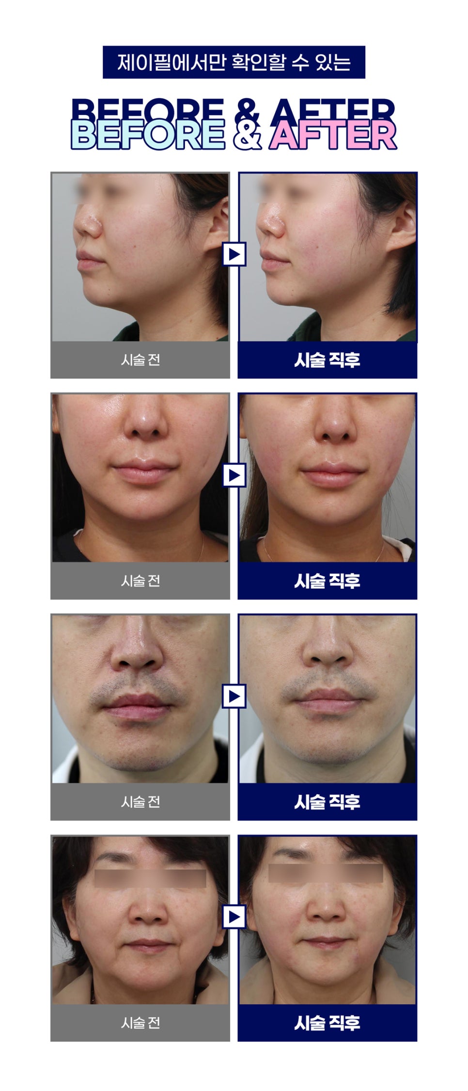 홍대 제이필 슈링크유니버스런칭! 지금 이뻐지기 시작하자! 관련 이미지 10