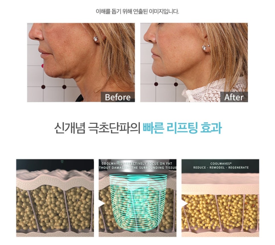 Hongdae Entrance Station Dermatology Clinic: “Onda Lifting” — You’ll Regret Missing It! (Special Promotion Ongoing⭐) image 4