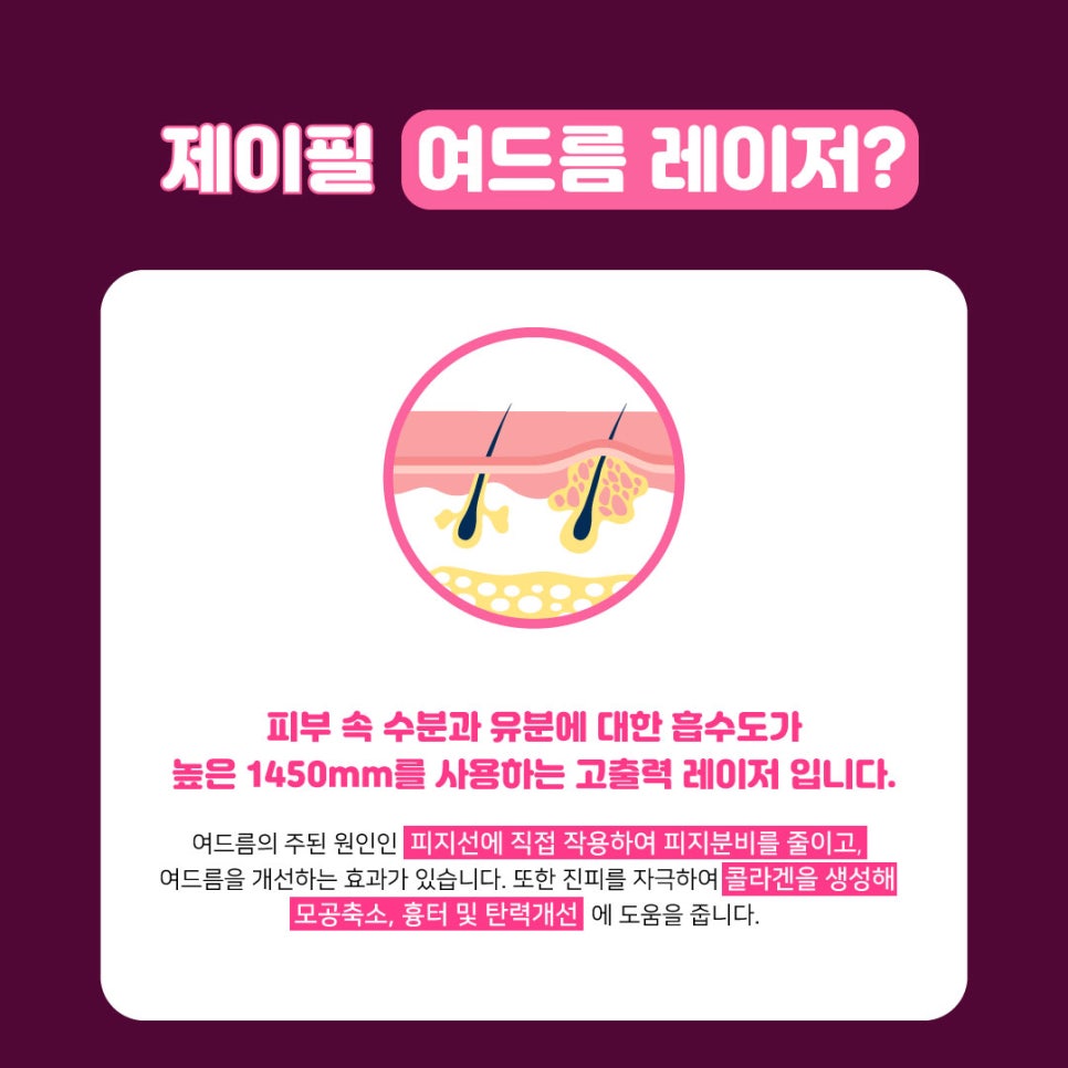 화농성여드름에도 탁월한 여드름레이저 관련 이미지 2