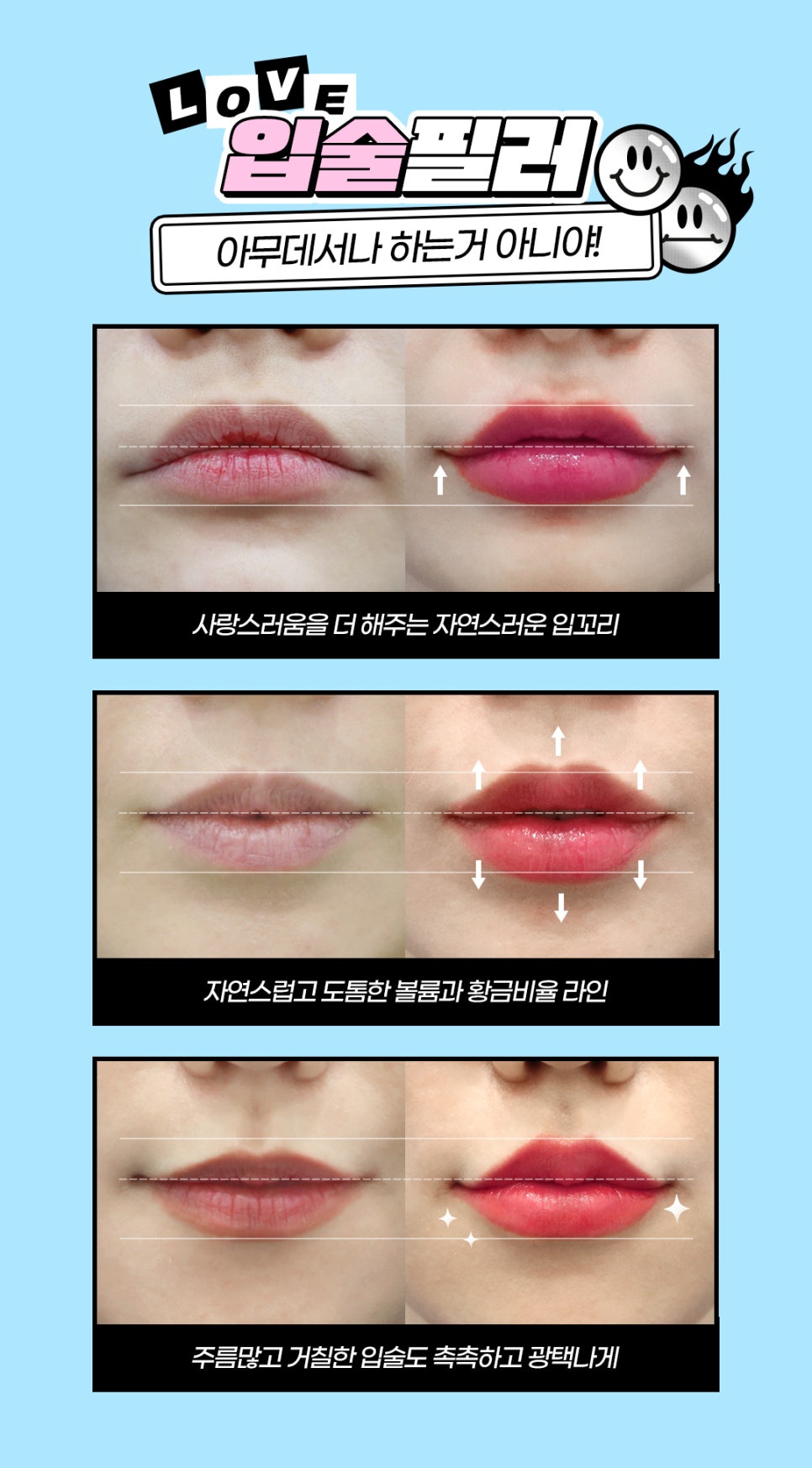 자연스러운 홍대입술필러로 볼륨 UP 매력 UP 관련 이미지 5