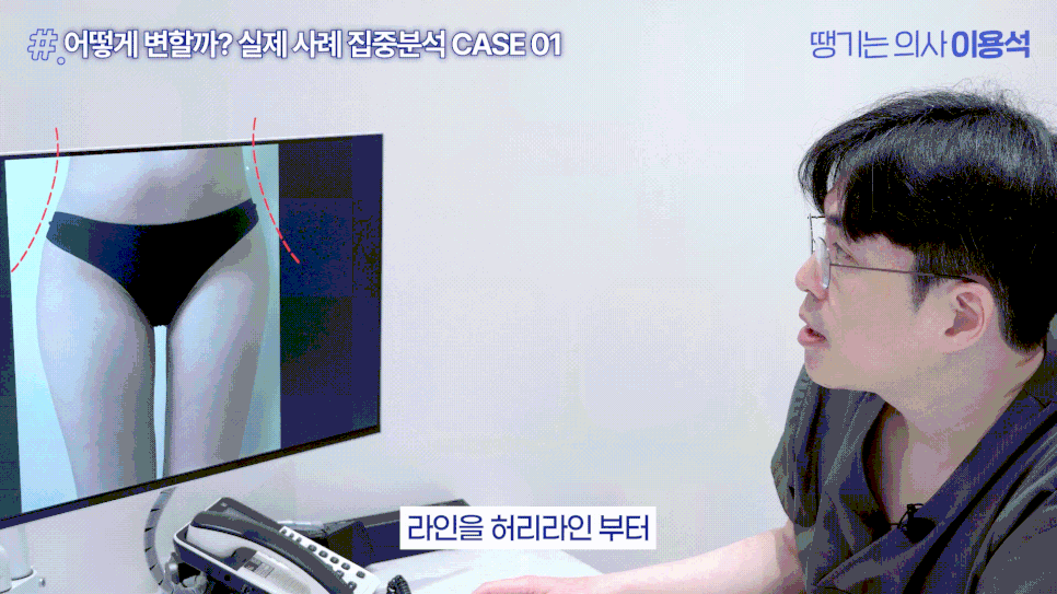 힙필러 전 꼭 알아야 할 사실|힙딥은 단순히 볼륨보다 구조가 중요합니다 관련 이미지 18