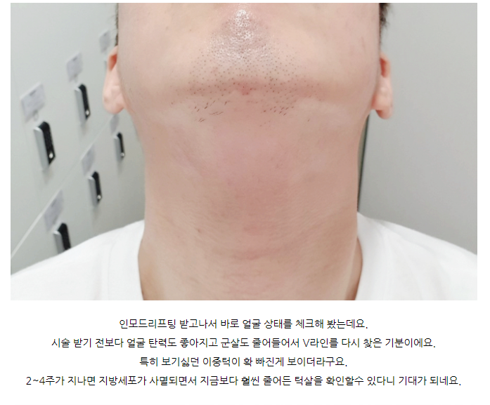 레이저리프팅, 지방을 죽이는 인모드 FX, 포마 후기 관련 이미지 1