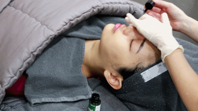 여드름 흉터 색소침착 걱정 말고 원인 찾아서 관리로 치료해요 관련 이미지 11