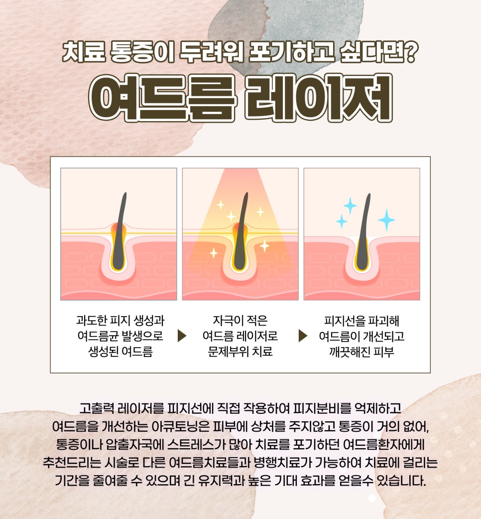 피지분비, 피지억제레이저로 여드름 끝장내기! 관련 이미지 5