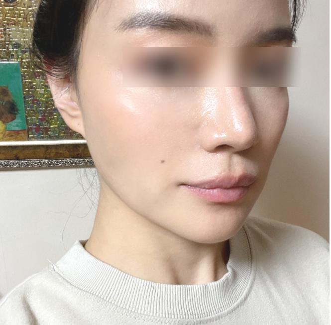 홍대 올리지오 리프팅 리얼 효과,후기 궁금하신가요? 관련 이미지 1