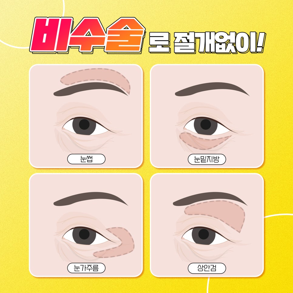 눈가주름관리, 탄력있는 피부개선을 원한가면 눈가레이저! 관련 이미지 3