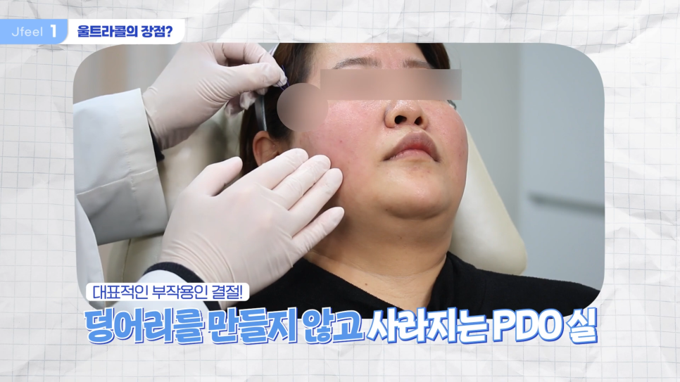 필러가 싫다면? 눈가, 팔자, 주름 해결하는 울트라콜 관련 이미지 4