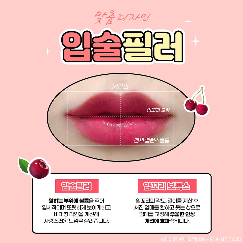 입술필러 잘하는 곳 제이필에서 부작용 걱정없이 사랑스럽게 관련 이미지 2