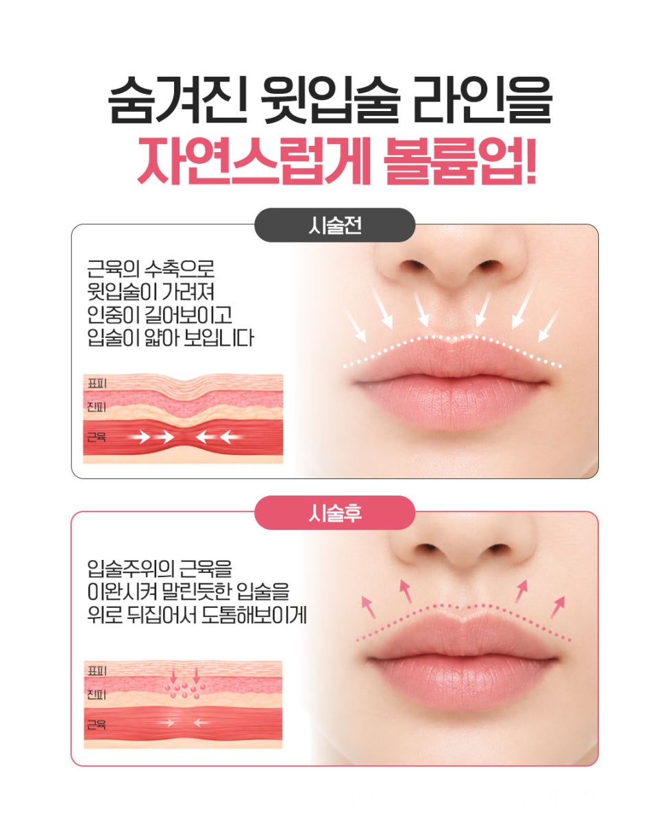 Concerned About a Long Face? The Real Reason Your Philtrum Looks Long—and When Sofwave May Help image 5