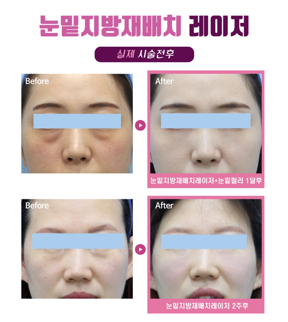 눈밑지방재배치 레이저 , 절개 없이 가능할까? 관련 이미지 4