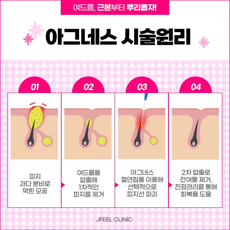 여드름과 흉터 개선에 도움을 주는 치료 방법 관련 이미지 11