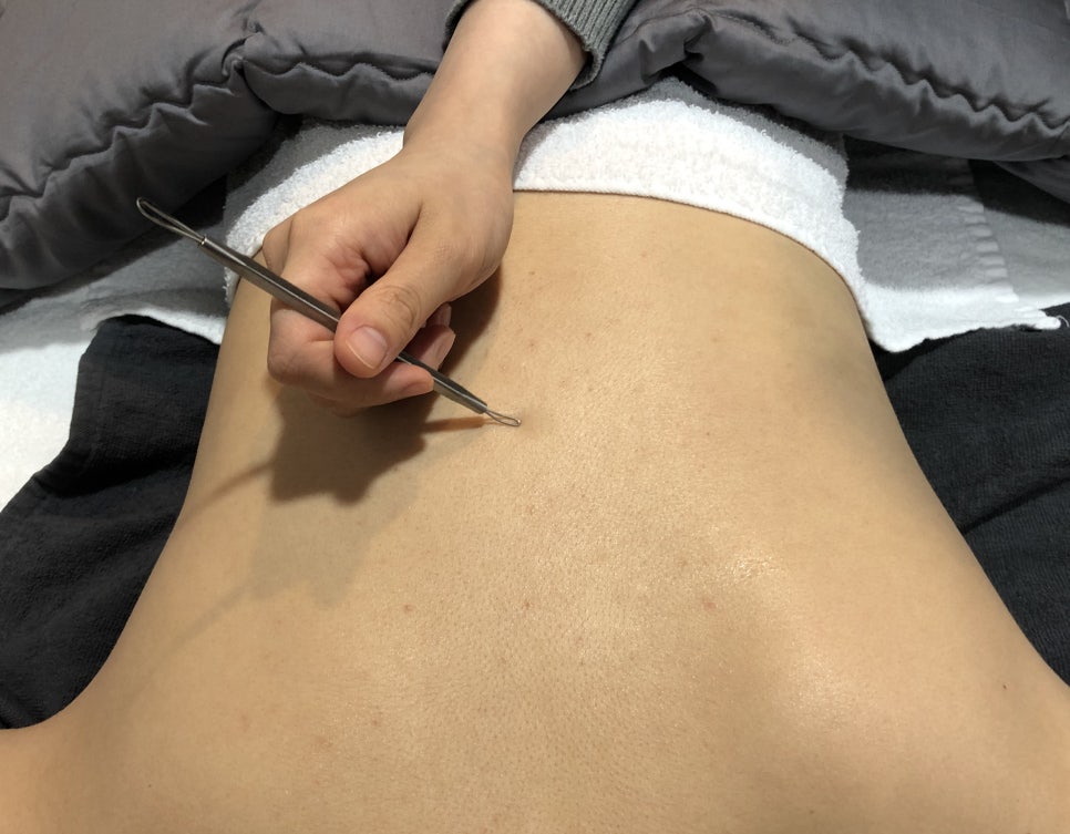 [홍대피부과] 다가오는 여름,  알라딘필링 로즈필  등여드름 박멸! 관련 이미지 7
