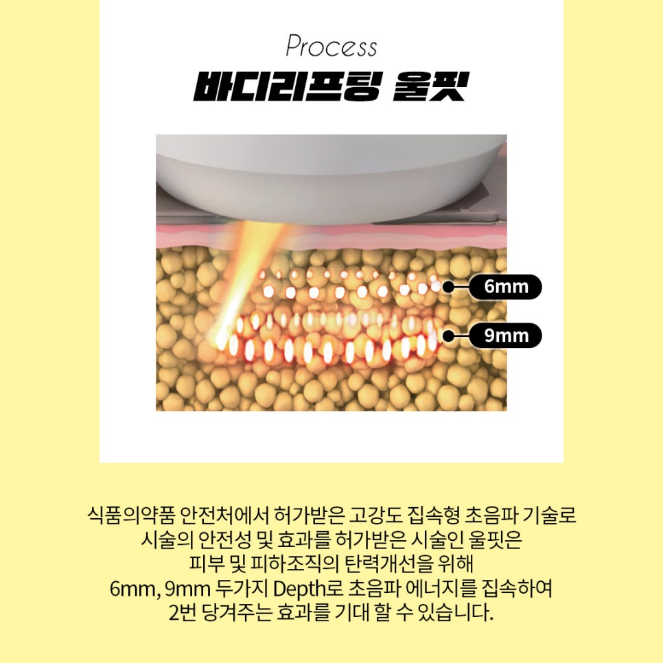 바디 슈링크, 울핏 리프팅효과 궁금하시다구요? 관련 이미지 3
