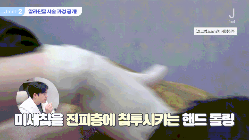 등 여드름 없애는법, 여름 등드름 고민엔 해초 미세침 알라딘필링? 관련 이미지 10
