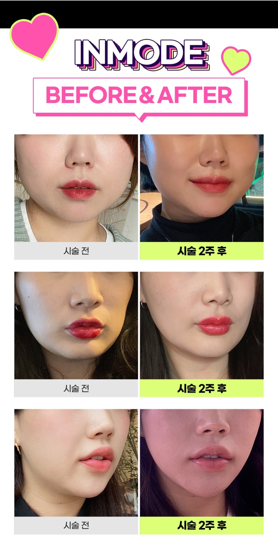 턱인모드, 늦기 전에 노마스크 하관 집중관리 관련 이미지 8