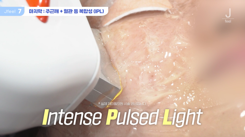 홍대 피부과 기미 잡티제거 레이저 및 구분법 관련 이미지 15