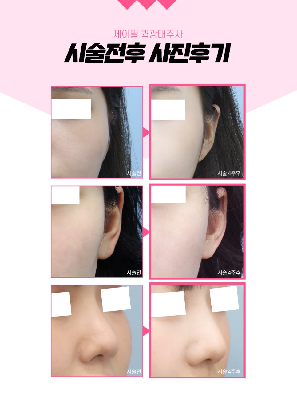 옆광대 앞광대 축소 수술말고 퀵광대주사로 효과보자 관련 이미지 7