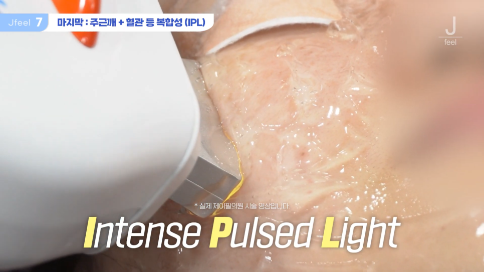 기미 주근깨 잡티에 이 시술만은 NO! 시술 전 필독 관련 이미지 14