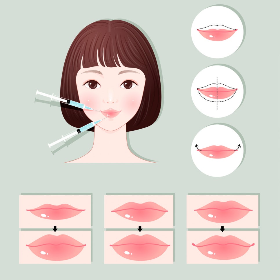 홍대피부과, 키스데이맞이 입술필러 이벤트 관련 이미지 9