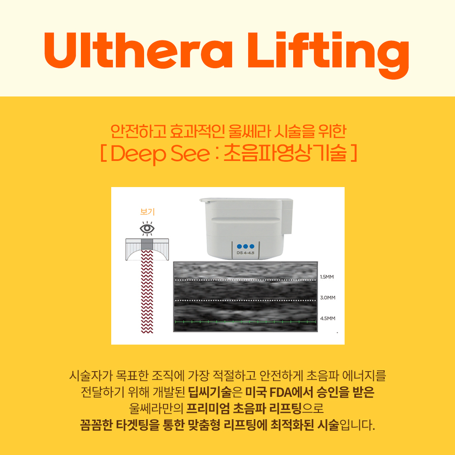 인모드,울쎄라를 이용한 리프팅 시술시 효과와 주의사항 관련 이미지 12