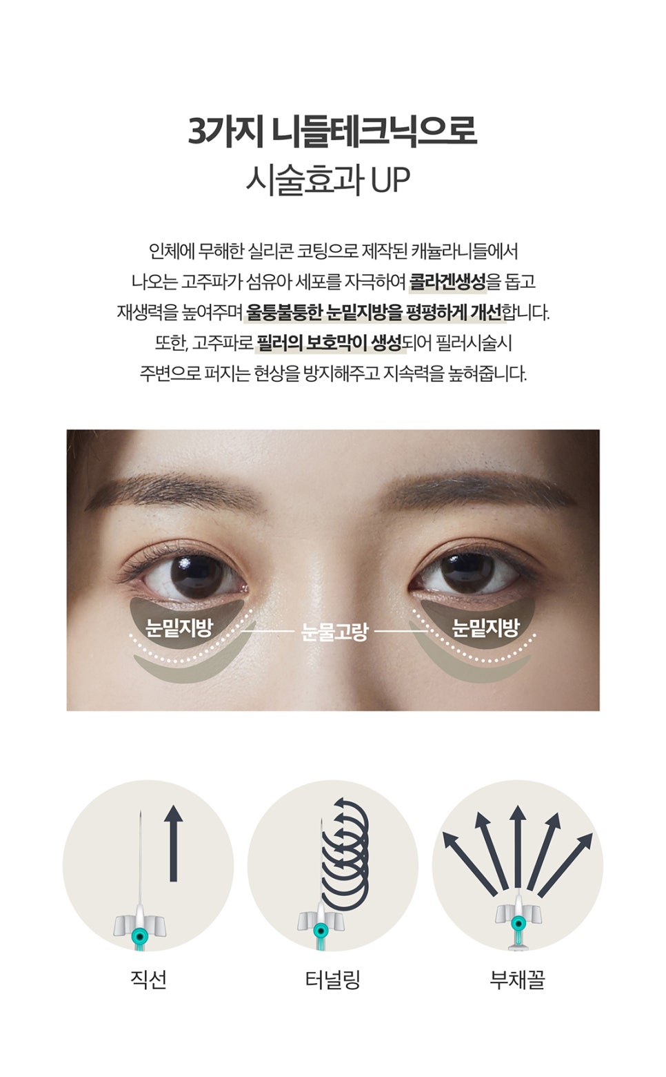 눈밑지방제거방법을 찾는다면? 비수술 비절개로! 관련 이미지 3