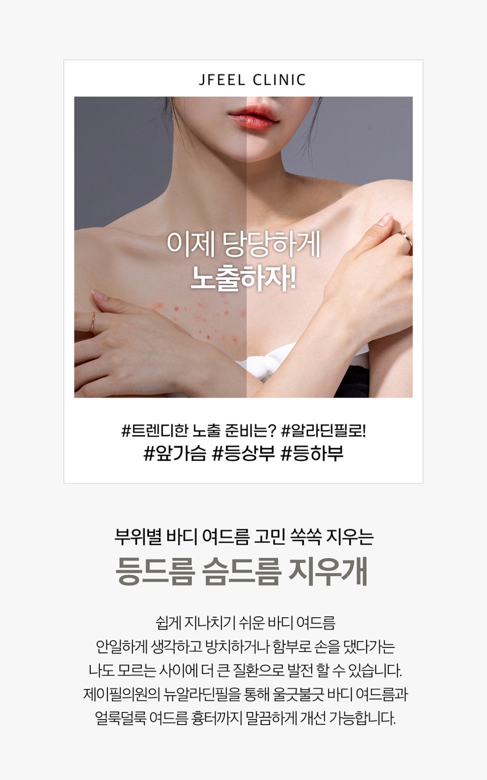 등드름제거는 알리딘필링으로 확실하게! 관련 이미지 3