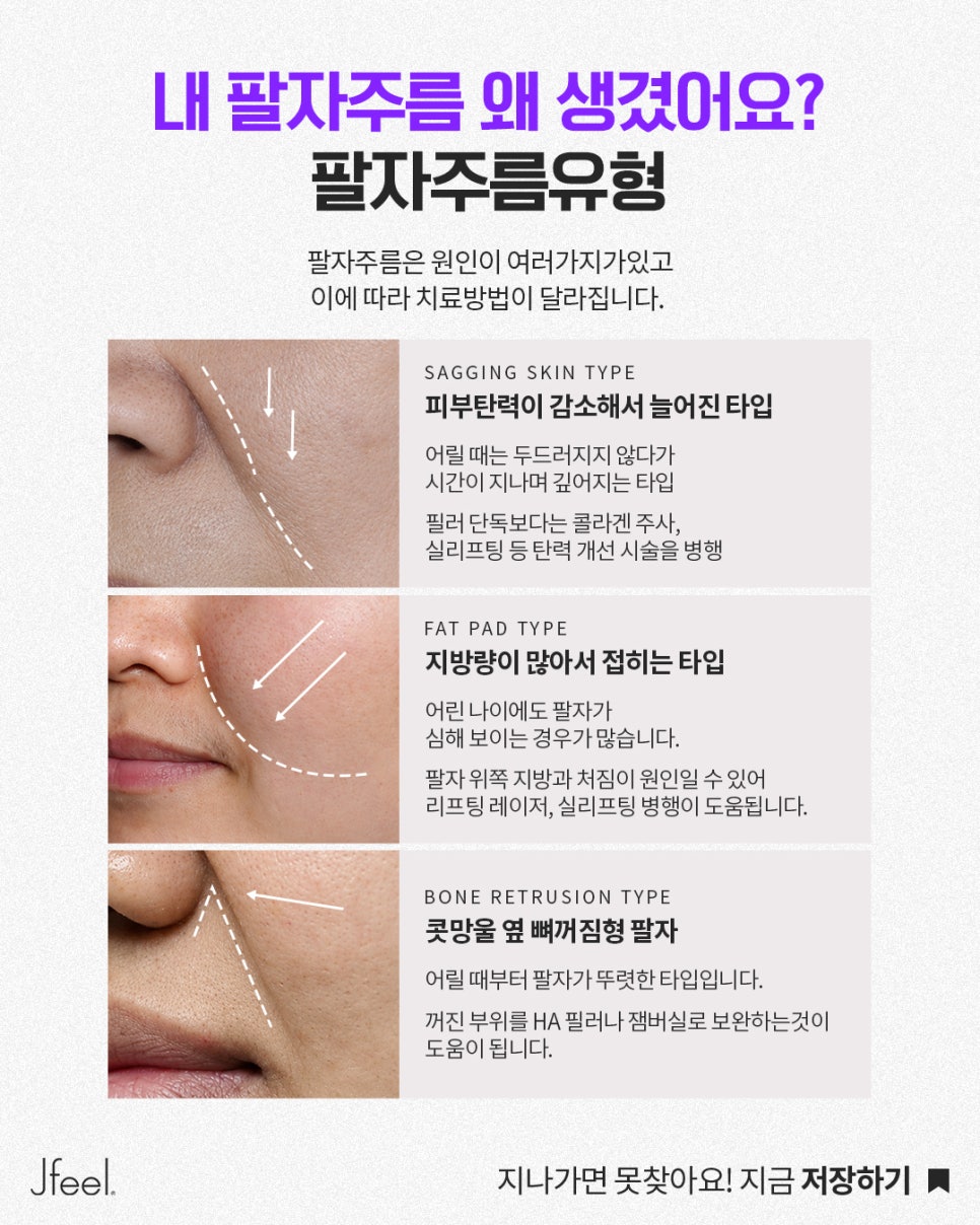 팔자 필러는 부담스러운데, 꺼진 팔자는 어떻게 개선할까요? | 무필러 팔자 관리 방법 관련 이미지 5