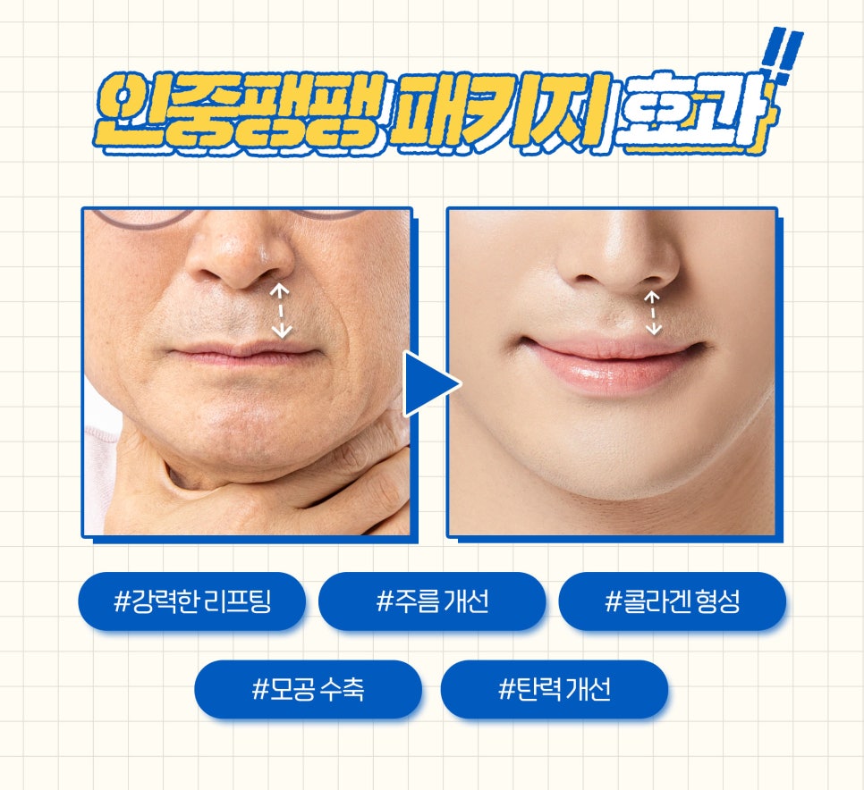 노화로 인해 늘어난 인중! 비수술 인중축소술로 개선해요 관련 이미지 3