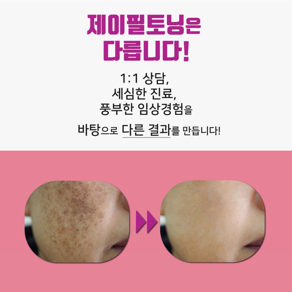 [홍대피부과] 제이필 레이저토닝-기미잡티제거는 제이필토닝으로 고민 해결! 관련 이미지 2