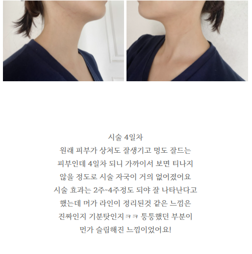 이중턱 지방분해 효과 확실한 인모드 FX 리프팅 후기 관련 이미지 2