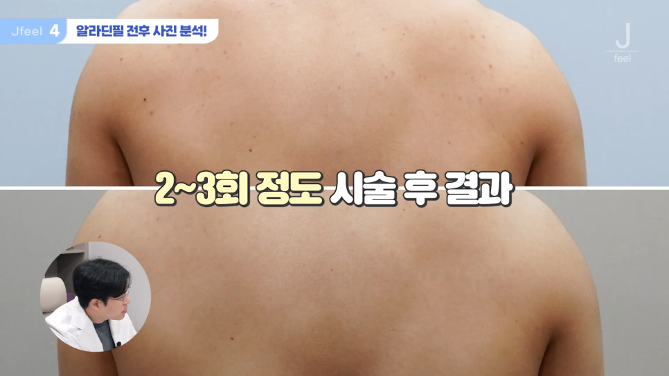 등여드름필링으로 연예인 등 만들기 관련 이미지 18