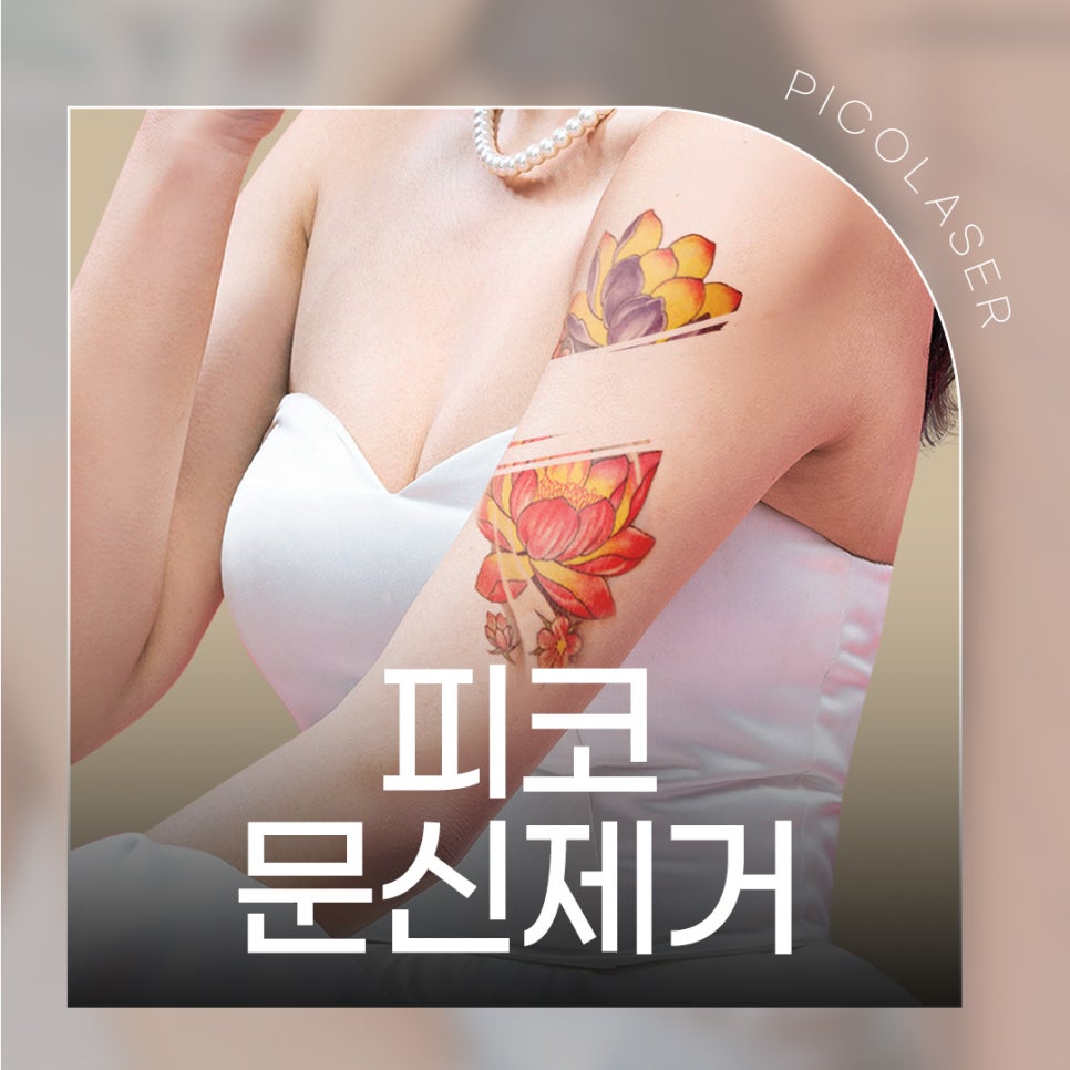 미니타투제거는 피코문신제거 레이저 관련 이미지 1
